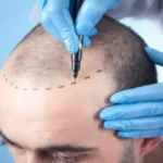 FUE Donor Harvesting for Hair Restoration