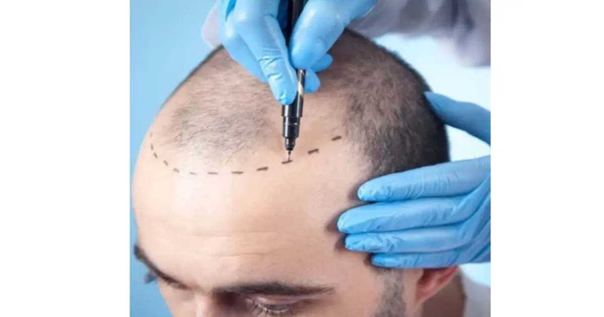 FUE Donor Harvesting for Hair Restoration